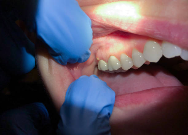Best Broken or Chipped Tooth Repair in Perryville, AR