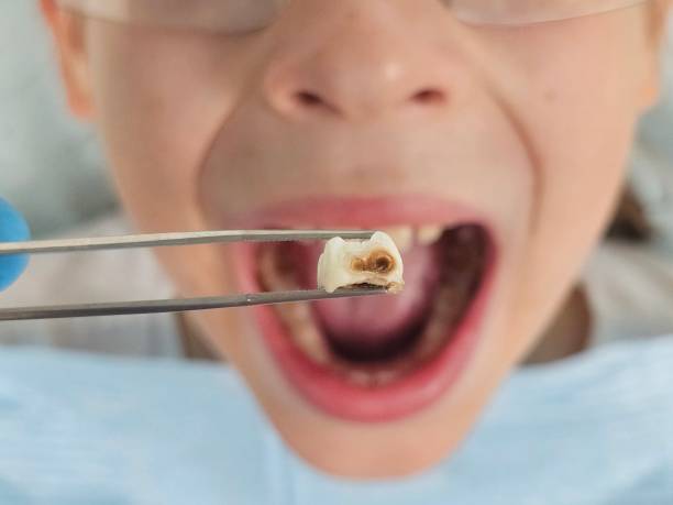 Best Emergency Wisdom Tooth Extraction in Perryville, AR